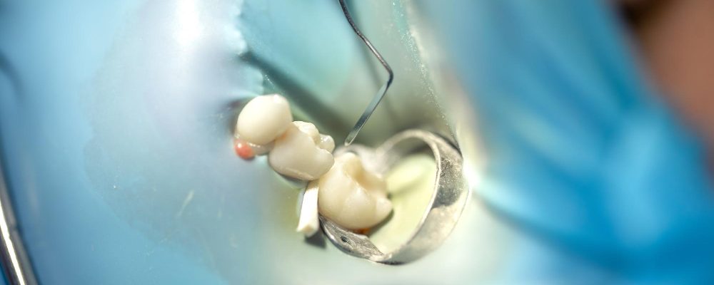fernando-sandoval-endodoncia-que-es