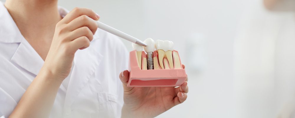 fernando-sandoval-implantes-que-es